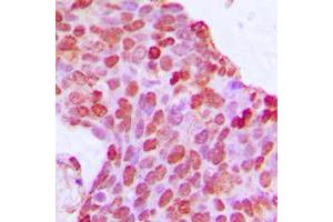 Immunohistochemical analysis of BCOR staining in human breast cancer formalin fixed paraffin embedded tissue section.