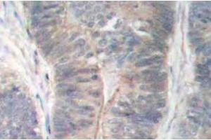 Immunohistochemistry (IHC) analyzes of p-PKR antibody in paraffin-embedded human colon carcinoma tissue. (EIF2AK2 抗体  (pThr451))