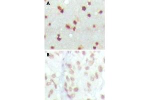 Immunohistochemical analysis of paraffin-embedded human cerebra (A) and lung carcinoma (B) tissue using MDM4 monoclonal antobody, clone 2D10F4 , showing nuclear localization with DAB staining. (MDM4-binding Protein 抗体)