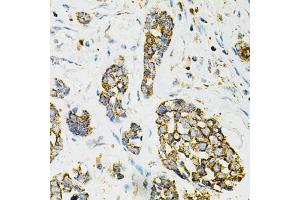 Immunohistochemistry of paraffin-embedded human esophageal cancer using ADSS antibody (ABIN6292806) at dilution of 1:100 (40x lens). (ADSS 抗体)