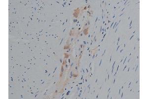 ABIN6256799 and ABIN6267420 at 1/50 staining human colon carcinoma tissue sections by IHC-P. (Phospholipase C gamma 1 抗体  (pTyr771))