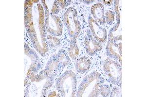 Immunohistochemical analysis of ARF4 staining in human colon cancer formalin fixed paraffin embedded tissue section. (ARF4 抗体  (Center))