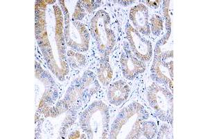 Immunohistochemical analysis of ARF4 staining in human colon cancer formalin fixed paraffin embedded tissue section.