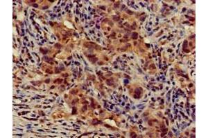 Immunohistochemistry of paraffin-embedded human pancreatic cancer using ABIN7145339 at dilution of 1:100 (ATG14 抗体  (AA 1-492))