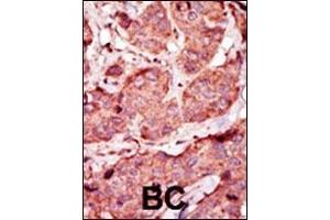 Formalin-fixed and paraffin-embedded human cancer tissue reacted with the primary antibody, which was peroxidase-conjugated to the secondary antibody, followed by AEC staining. (PFKP 抗体  (C-Term))