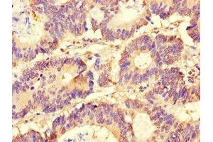 Immunohistochemistry of paraffin-embedded human colon cancer using ABIN7153920 at dilution of 1:100 (SLC37A1 抗体  (AA 245-302))