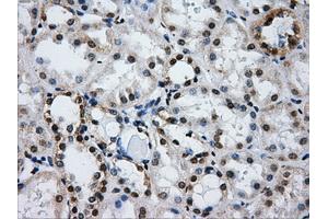 Immunohistochemical staining of paraffin-embedded Carcinoma of liver tissue using anti-IFIT3mouse monoclonal antibody. (IFIT3 抗体)