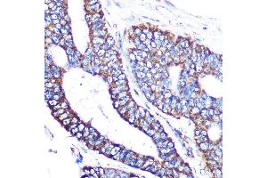 Immunohistochemistry of paraffin-embedded human colon carcinoma using MTCO2 Rabbit mAb (ABIN7266638) at dilution of 1:100 (40x lens). (COX2 抗体)