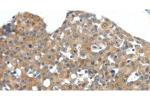 Immunohistochemistry of paraffin-embedded Human esophagus cancer tissue using SCN11A Polyclonal Antibody at dilution 1:40 (SCN11A 抗体)