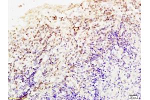 Formalin-fixed and paraffin embedded Human endometrium carcinoma labeled Anti-Livin Polyclonal Antibody, Unconjugated  at 1:200, followed by conjugation to the secondary antibody and DAB staining (BIRC7 抗体  (AA 101-200))