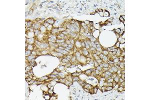 Immunohistochemistry of paraffin-embedded human colon carcinoma using TR antibody (ABIN3023477, ABIN3023478, ABIN3023479 and ABIN6220053) at dilution of 1:50 (40x lens). (TRAF7 抗体)
