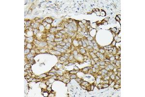 Immunohistochemistry of paraffin-embedded human colon carcinoma using TR antibody (ABIN3023477, ABIN3023478, ABIN3023479 and ABIN6220053) at dilution of 1:50 (40x lens).