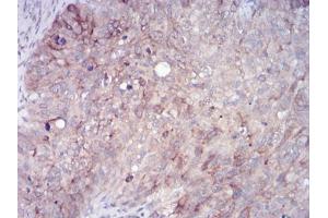 Immunohistochemical analysis of paraffin-embedded cervical cancer tissues using RAB11FIP1 mouse mAb with DAB staining. (RAB11FIP1 抗体  (AA 130-271))