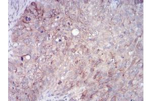 Immunohistochemical analysis of paraffin-embedded cervical cancer tissues using RAB11FIP1 mouse mAb with DAB staining.