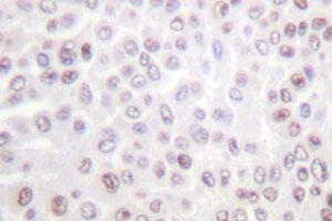 Immunohistochemical analysis of paraffin-embedded human breast cancer tissue using H2BFS polyclonal antibody . (H2BFS 抗体)
