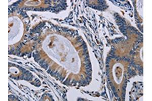 The image on the left is immunohistochemistry of paraffin-embedded Human colon cancer tissue using ABIN7191804(PCDHAC1 Antibody) at dilution 1/50, on the right is treated with synthetic peptide. (PCDHAC1 抗体)