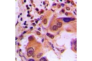 Immunohistochemical analysis of BRCA1 (pS1423) staining in human lung cancer formalin fixed paraffin embedded tissue section. (BRCA1 抗体  (C-Term, pSer1423))