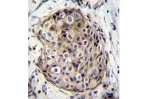 Immunohistochemistry analysis in formalin fixed and paraffin embedded human breast carcinoma reacted with GMP reductase 1 / GMPR1 Antibody (C-term) followed by peroxidase conjugation of the secondary antibody and DAB staining. (GMPR 抗体  (C-Term))