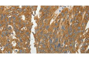 Immunohistochemistry of paraffin-embedded Human ovarian cancer using RPLP0 Polyclonal Antibody at dilution of 1:40 (RPLP0 抗体)