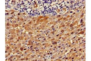 Immunohistochemistry of paraffin-embedded human liver cancer using ABIN7144595 at dilution of 1:100 (ASL 抗体  (AA 2-300))