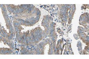 ABIN6274649 at 1/100 staining Human cervical cancer tissue by IHC-P. (CYP2E1 抗体  (Internal Region))