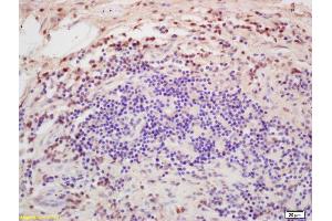 Formalin-fixed and paraffin embedded human colon carcinoma labeled with Rabbit Anti DGAT1/Diglyceride acyltransferase Polyclonal Antibody, Unconjugated (ABIN679568) at 1:200 followed by conjugation to the secondary antibody and DAB staining (DGAT1 抗体  (AA 251-350))