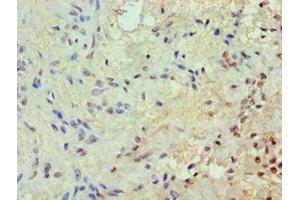 Immunohistochemistry of paraffin-embedded human breast cancer using ABIN7172569 at dilution of 1:100 (JunB 抗体  (AA 1-240))