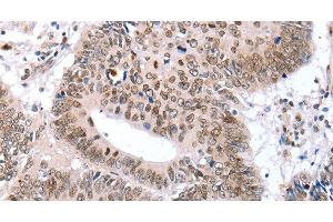 Immunohistochemistry of paraffin-embedded Human colon cancer tissue using TBX2 Polyclonal Antibody at dilution 1:32 (TBX2 抗体)