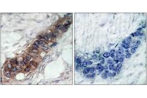 Immunohistochemistry analysis of paraffin-embedded human breast carcinoma tissue, using JAK2 (Ab-221) Antibody. (JAK2 抗体  (AA 191-240))