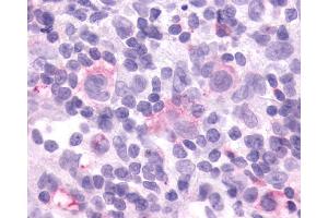 Anti-CCR9 antibody IHC of human Lymph Node, Hodgkins Lymphoma. (CCR9 抗体  (Cytoplasmic Domain))