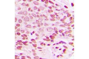 Immunohistochemical analysis of c-Jun (pT93) staining in human breast cancer formalin fixed paraffin embedded tissue section.