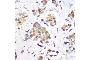 Immunohistochemistry of paraffin-embedded human breast cancer using KDM1 / LSD1 Rabbit mAb (ABIN7268324) at dilution of 1:100 (40x lens). (LSD1 抗体)
