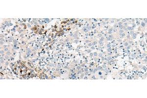 Immunohistochemistry of paraffin-embedded Human cervical cancer tissue using GUCA1B Polyclonal Antibody at dilution of 1:45(x200) (GUCA1B 抗体)