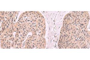 Immunohistochemistry of paraffin-embedded Human esophagus cancer tissue using KLRB1 Polyclonal Antibody at dilution of 1:55(x200) (CD161 抗体)