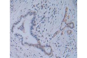 IHC-P analysis of Human Pancreas Cancer Tissue, with DAB staining. (TICAM1 抗体  (AA 443-685))