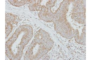IHC-P Image Immunohistochemical analysis of paraffin-embedded human colon carcinoma, using Factor IX, antibody at 1:250 dilution. (Coagulation Factor IX 抗体)