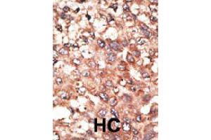 Formalin-fixed and paraffin-embedded human hepatocellular carcinoma tissue reacted with BMP5 polyclonal antibody  , which was peroxidase-conjugated to the secondary antibody, followed by AEC staining. (BMP5 抗体  (N-Term))