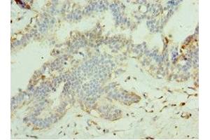Immunohistochemistry of paraffin-embedded human breast cancer using ABIN7159998 at dilution of 1:100 (MAPK15 抗体  (AA 1-95))