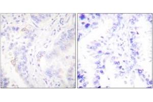 Immunohistochemistry analysis of paraffin-embedded human lung carcinoma tissue, using CrkII (Ab-221) Antibody. (Crk 抗体  (AA 187-236))