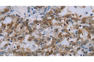 Immunohistochemistry of paraffin-embedded Human liver cancer tissue using MED12 Polyclonal Antibody at dilution 1:40 (MED12 抗体)