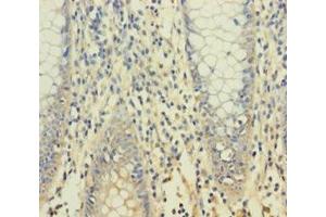 Immunohistochemistry of paraffin-embedded human colon cancer using ABIN7166354 at dilution of 1:100 (YPEL1 抗体  (AA 1-119))