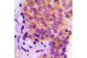 Immunohistochemical analysis of Galectin 9 staining in human breast cancer formalin fixed paraffin embedded tissue section. (Galectin 9 抗体  (Center))