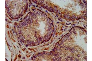 IHC image of ABIN7160835 diluted at 1:300 and staining in paraffin-embedded human prostate cancer performed on a Leica BondTM system. (NLRP7 抗体  (AA 89-187))