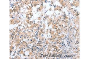 Immunohistochemistry of Human prostate cancer using CD200R1 Polyclonal Antibody at dilution of 1:70 (HCRTR2 抗体)