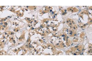 Immunohistochemistry of paraffin-embedded Human thyroid cancer using CYR61 Polyclonal Antibody at dilution of 1:60 (CYR61 抗体)