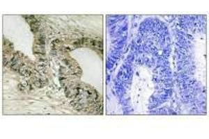 Immunohistochemistry analysis of paraffin-embedded human colon carcinoma tissue using GRB2 (Ab-159) antibody. (GAB2 抗体  (Ser159))