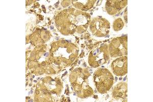 Immunohistochemistry of paraffin-embedded Human gastric using Tp53 antibody at dilution of 1:100 (x400 lens). (p53 抗体)