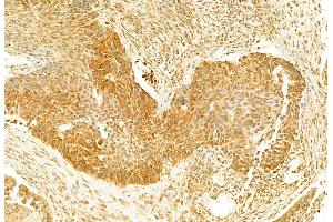 ABIN6262106 and ABIN6273119 at 1/100 staining Human lung cancer by IHC-P.