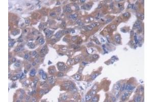 Detection of a2M in Human Liver cancer Tissue using Monoclonal Antibody to Alpha-2-Macroglobulin (a2M) (alpha 2 Macroglobulin 抗体  (AA 616-856))