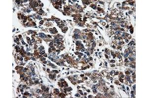 Immunohistochemical staining of paraffin-embedded Carcinoma of liver tissue using anti-FAHD2Amouse monoclonal antibody. (FAHD2A 抗体)